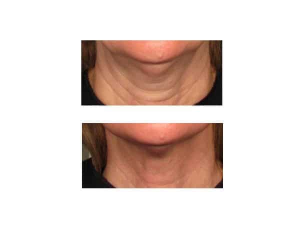 Neck Lines Before and After (Boletro)