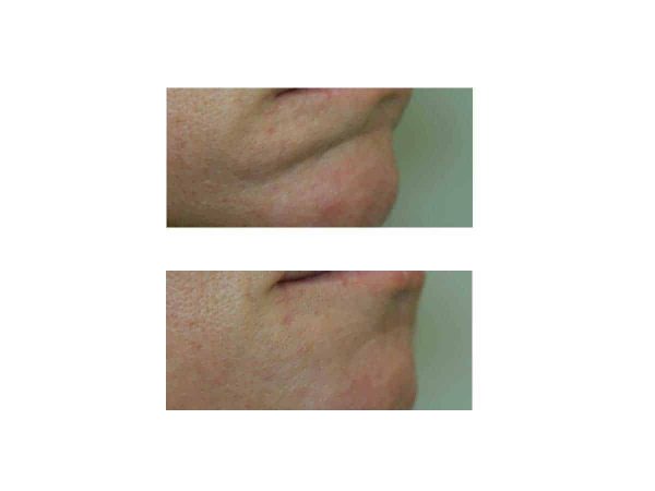 Chin Crease Before and After (Boletro)