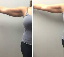 A woman quickly losing fat off her arms with Ultratone at VL Aesthetics in Carlisle (Cumbria)