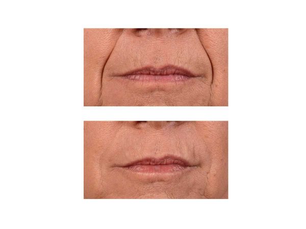 A before and after photo of Laugh Lines Fillers at VL Aesthetics in Carlisle (Cumbria)