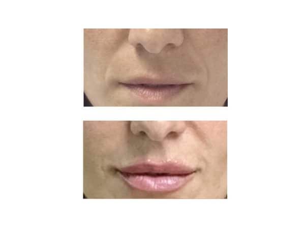 A before and after photo of Smile Lines Fillers at VL Aesthetics in Carlisle (Cumbria)