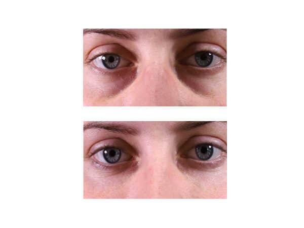 A before after photo of a woman getting rid of dark circles under her eyes at VL Aesthetics in Carlisle (Cumbria)