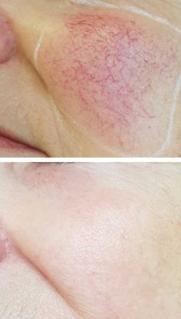 A before after photo of a woman quickly getting rid of thread veins on her face with the Cynosure laser